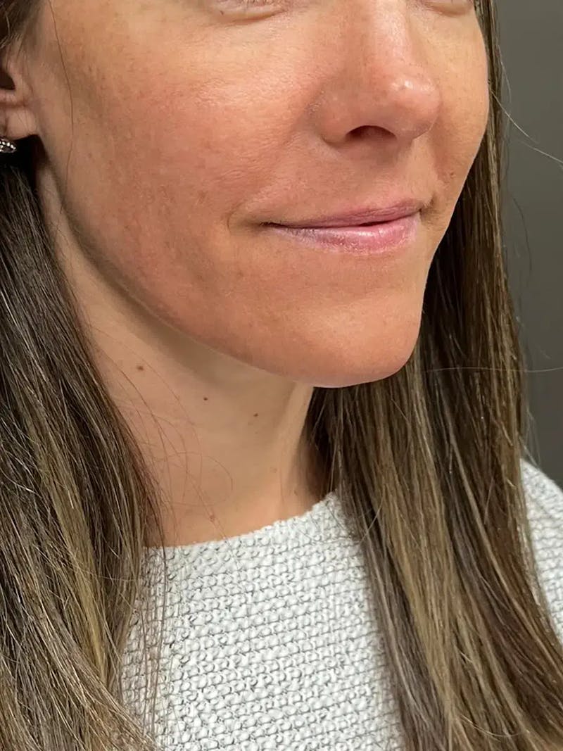 Sculptra Before & After Gallery - Patient 218005 - Image 4