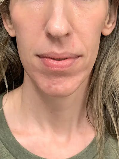 Sculptra Before & After Gallery - Patient 317564 - Image 1