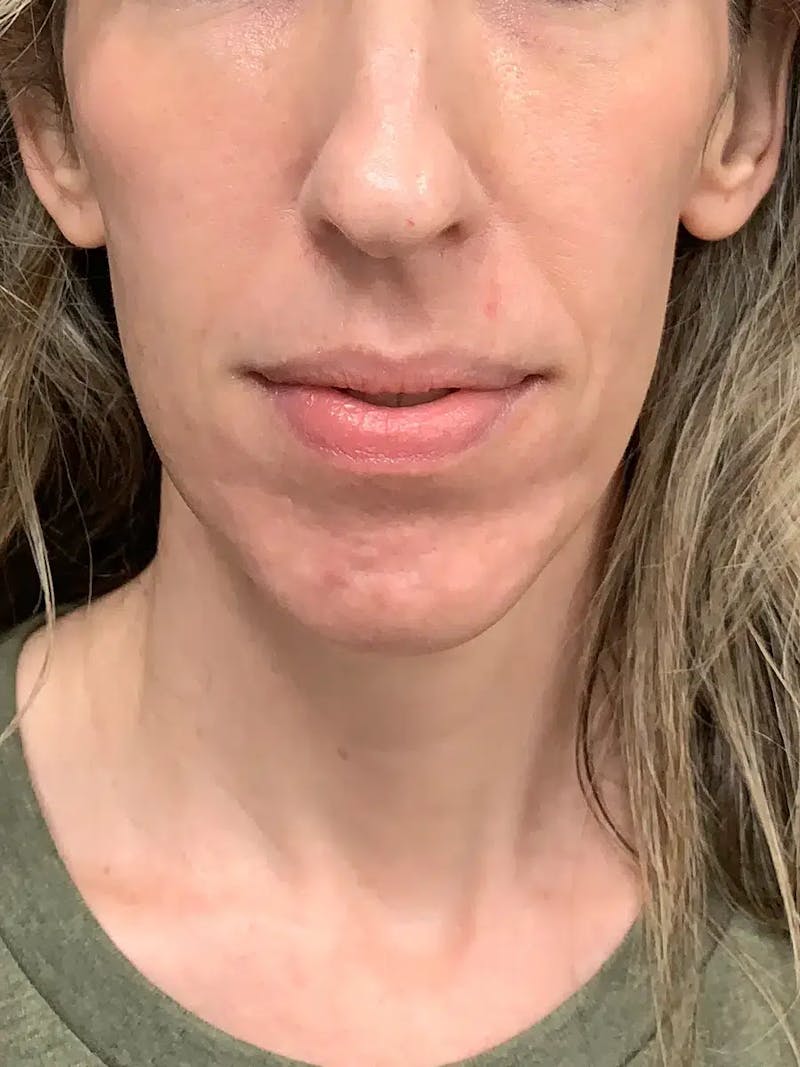 Sculptra Before & After Gallery - Patient 317564 - Image 1