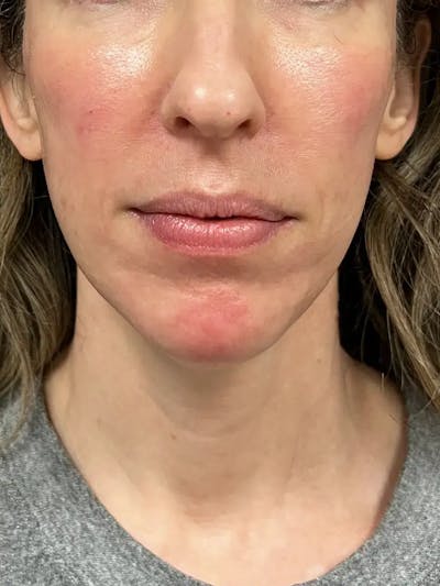Sculptra Before & After Gallery - Patient 317564 - Image 2