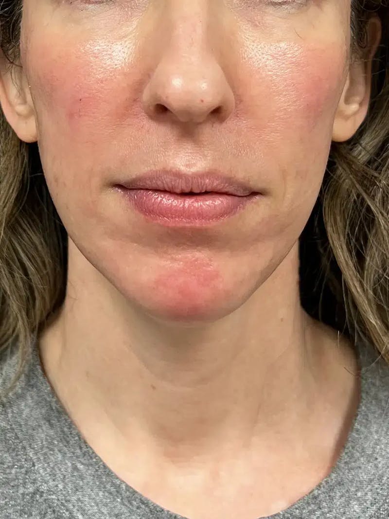 Sculptra Before & After Gallery - Patient 317564 - Image 2