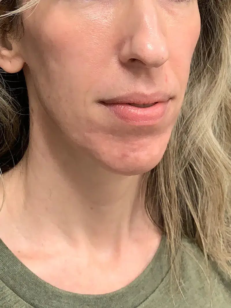 Sculptra Before & After Gallery - Patient 317564 - Image 3