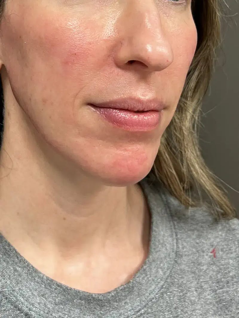 Sculptra Before & After Gallery - Patient 317564 - Image 4