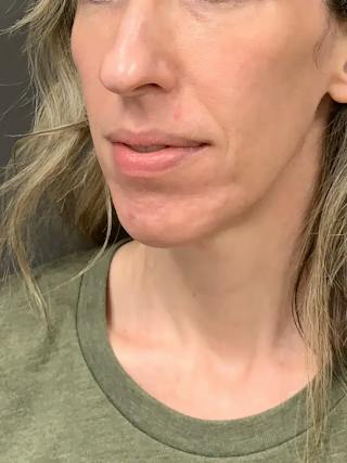 Biostimulators Before & After Gallery - Patient 317564 - Image 6
