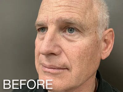 Under Eye Filler Before & After Gallery - Patient 557448 - Image 1