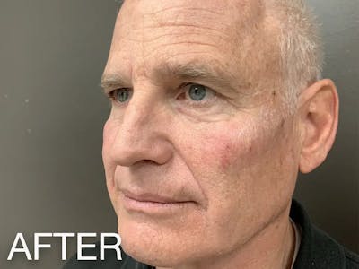 Under Eye Filler Before & After Gallery - Patient 557448 - Image 2