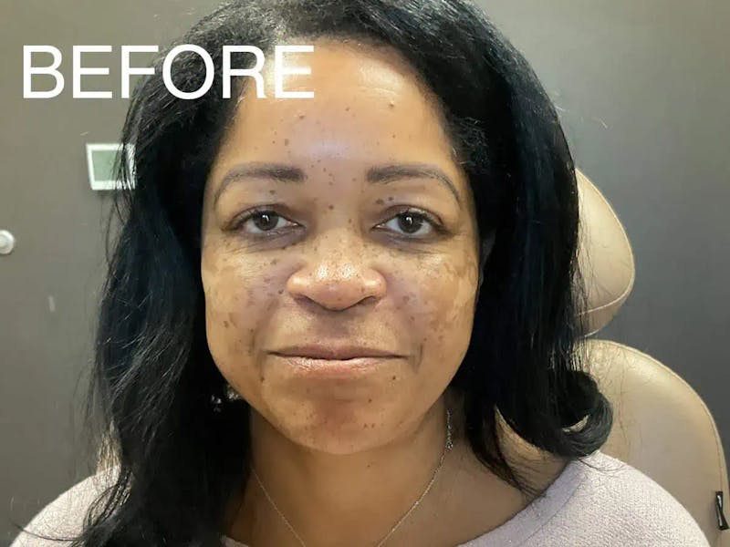 Skin Care Protocol Before & After Gallery - Patient 852493 - Image 1