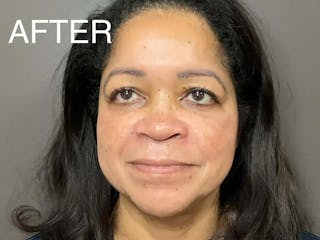 Skin Care Protocol Before & After Gallery - Patient 852493 - Image 2