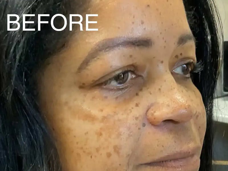 Skin Care Protocol Before & After Gallery - Patient 852493 - Image 3