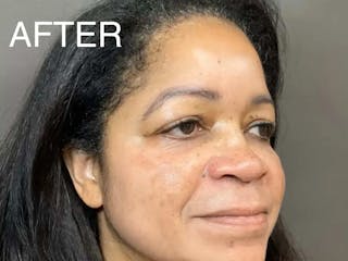 Skin Care Protocol Before & After Gallery - Patient 852493 - Image 4