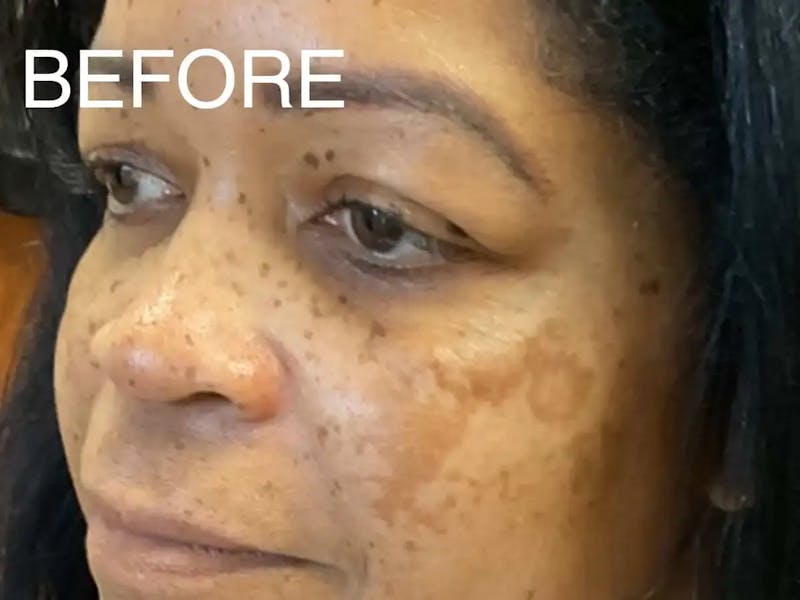 Skin Care Protocol Before & After Gallery - Patient 852493 - Image 5
