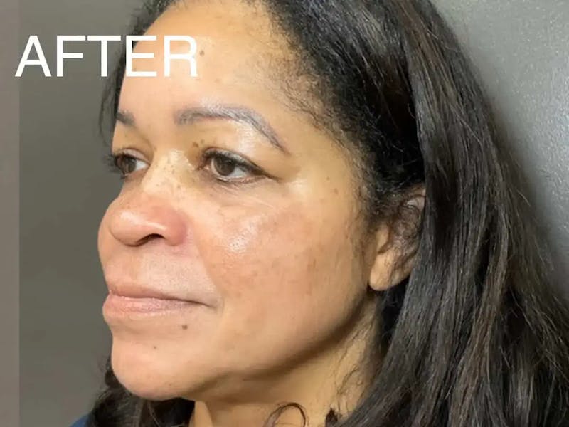 Skin Care Protocol Before & After Gallery - Patient 852493 - Image 6