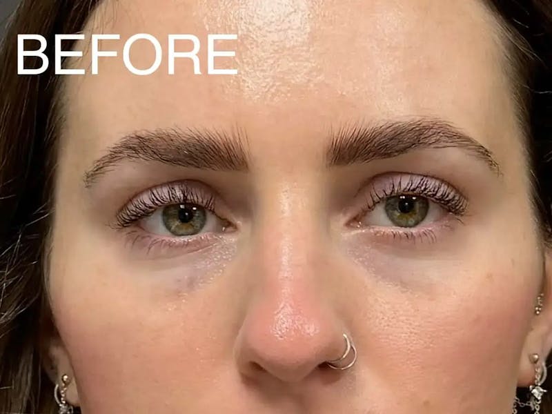 Under Eye Filler Before & After Gallery - Patient 272826 - Image 1