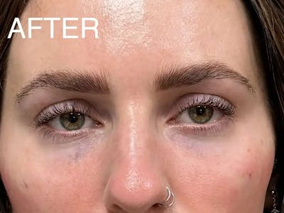 Under Eye Filler Before & After Gallery - Patient 272826 - Image 2