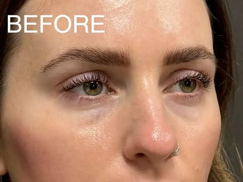 Under Eye Filler Before & After Gallery - Patient 272826 - Image 3
