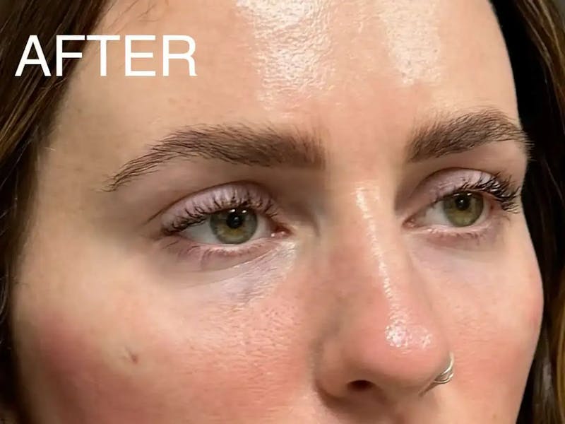 Under Eye Filler Before & After Gallery - Patient 272826 - Image 4
