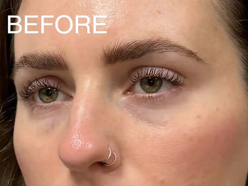 Under Eye Filler Before & After Gallery - Patient 272826 - Image 5