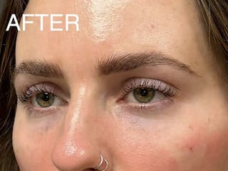 Under Eye Filler Before & After Gallery - Patient 272826 - Image 6
