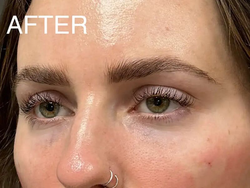 Under Eye Filler Before & After Gallery - Patient 272826 - Image 6