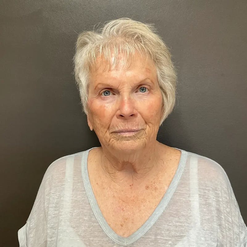 AURI Sculpt & Restore Before & After Gallery - Patient 416166 - Image 1