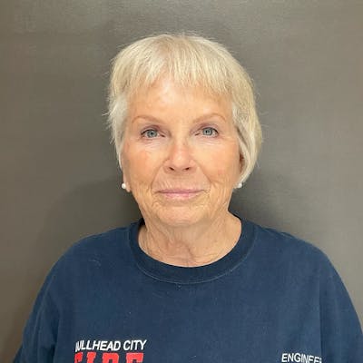 AURI Sculpt & Restore Before & After Gallery - Patient 416166 - Image 2