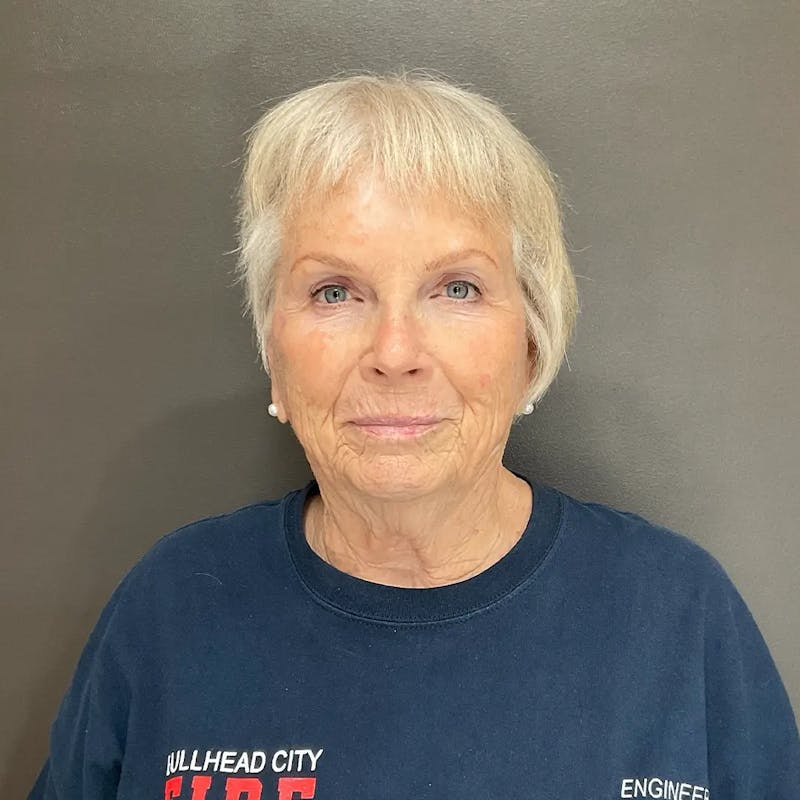 AURI Sculpt & Restore Before & After Gallery - Patient 416166 - Image 2