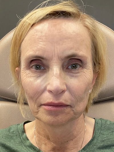 AURI Sculpt & Restore Before & After Gallery - Patient 129935 - Image 1