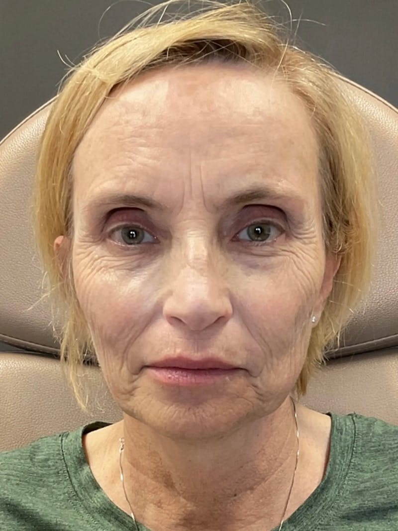 AURI Sculpt & Restore Before & After Gallery - Patient 129935 - Image 1