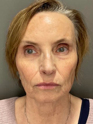 AURI Sculpt & Restore Before & After Gallery - Patient 129935 - Image 2