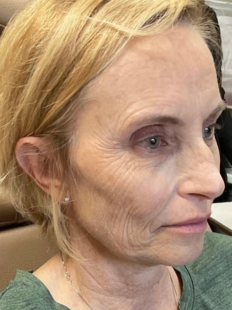 AURI Sculpt & Restore Before & After Gallery - Patient 129935 - Image 3