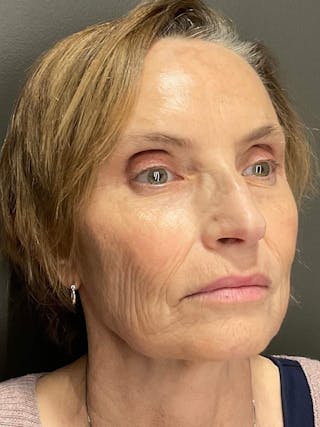 AURI Sculpt & Restore Before & After Gallery - Patient 129935 - Image 4