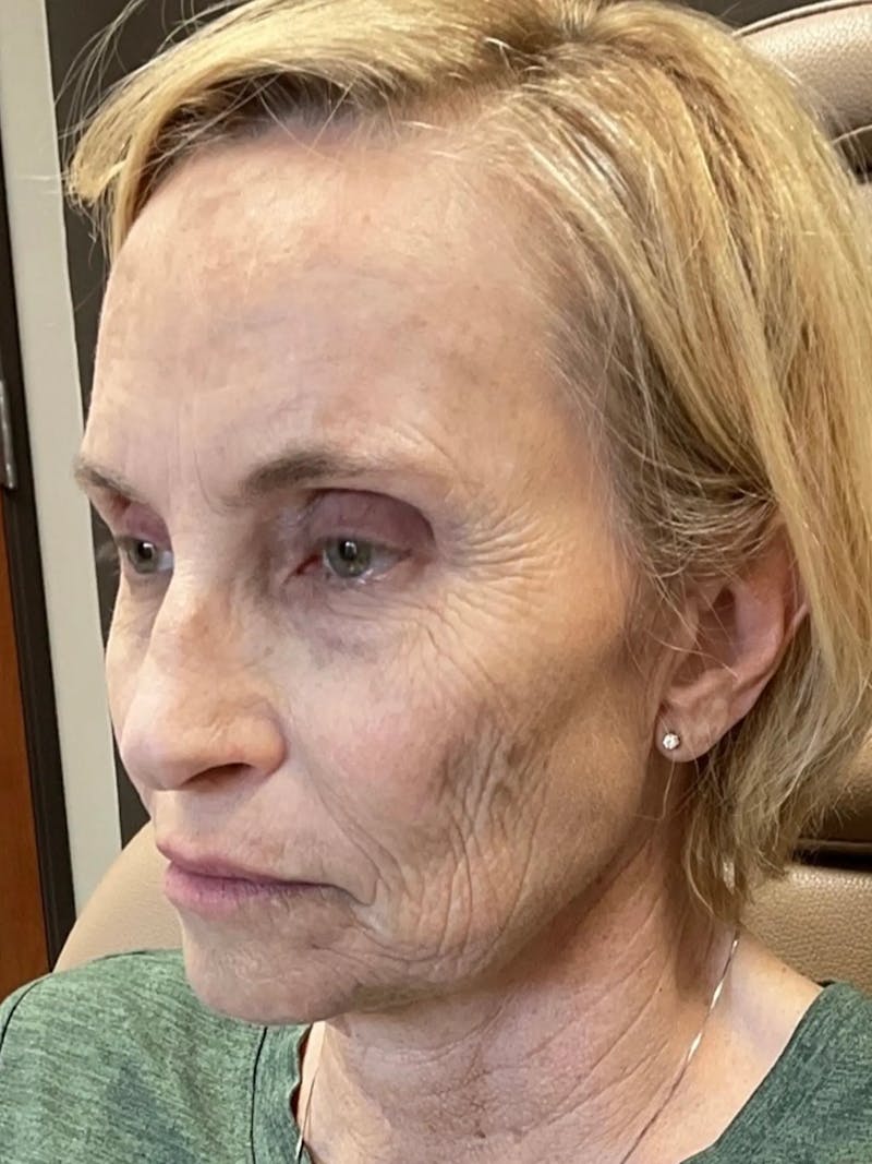 AURI Sculpt & Restore Before & After Gallery - Patient 129935 - Image 5