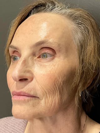 AURI Sculpt & Restore Before & After Gallery - Patient 129935 - Image 6