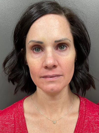 Full Face Rejuvenation Before & After Gallery - Patient 950662 - Image 1