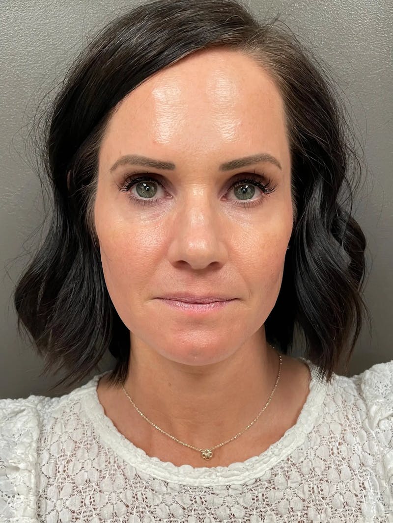Full Face Rejuvenation Before & After Gallery - Patient 950662 - Image 2