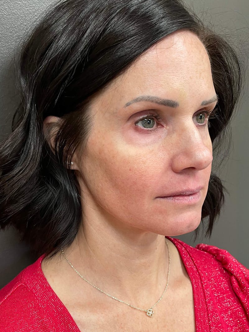 Full Face Rejuvenation Before & After Gallery - Patient 950662 - Image 3