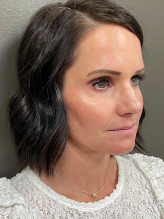 Full Face Rejuvenation Before & After Gallery - Patient 950662 - Image 4