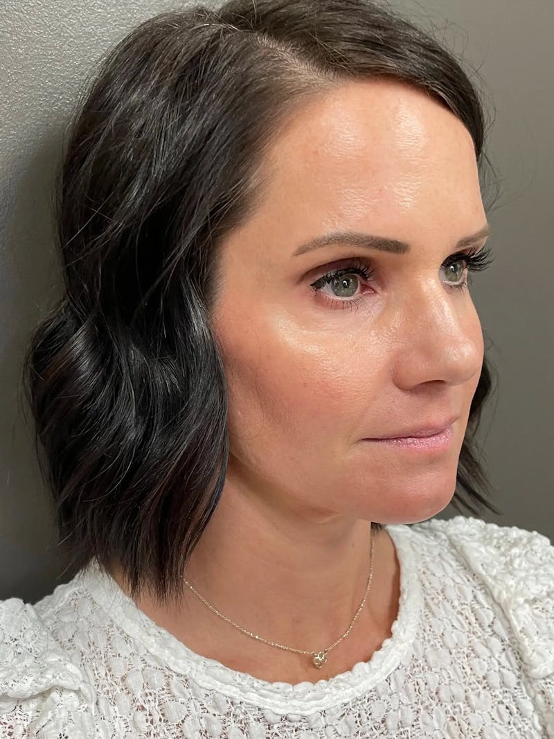 Full Face Rejuvenation Before & After Gallery - Patient 950662 - Image 4