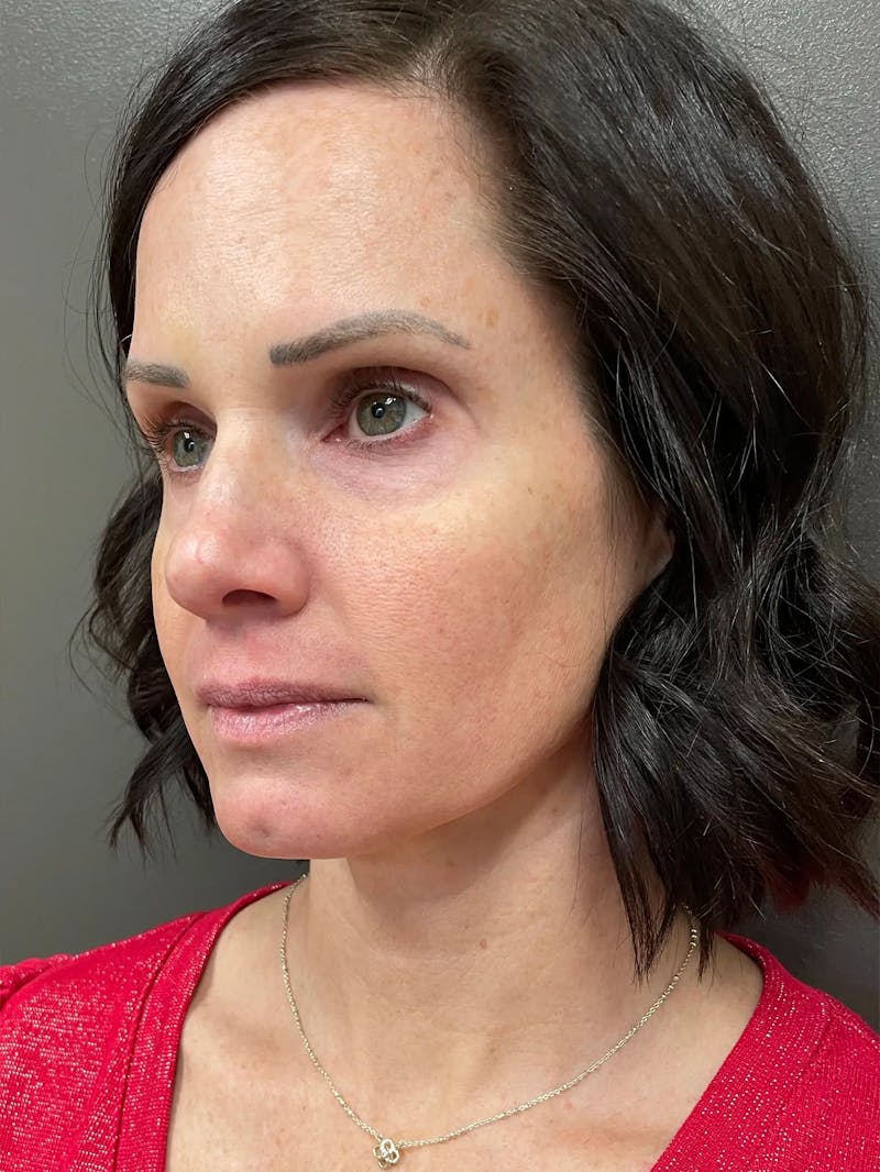Full Face Rejuvenation Before & After Gallery - Patient 950662 - Image 5