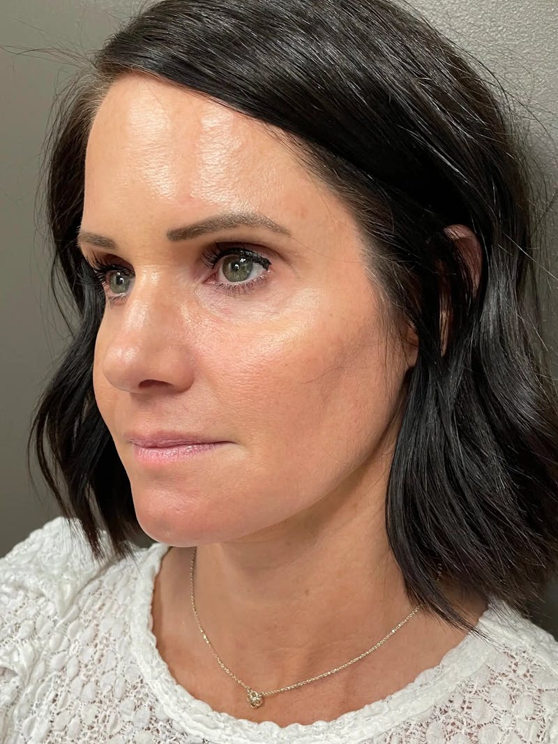 Full Face Rejuvenation Before & After Gallery - Patient 950662 - Image 6