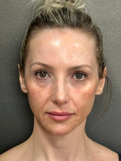Full Face Rejuvenation Before & After Gallery - Patient 257029 - Image 1