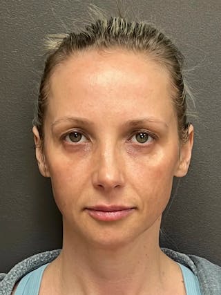 Full Face Rejuvenation Before & After Gallery - Patient 257029 - Image 2