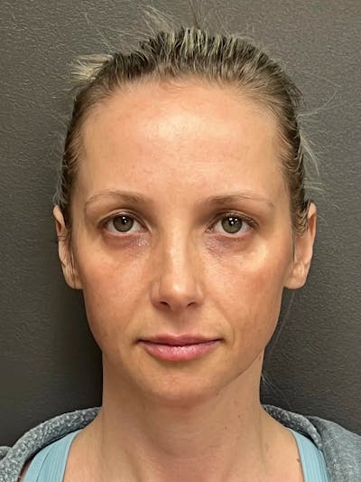 Full Face Rejuvenation Before & After Gallery - Patient 257029 - Image 2