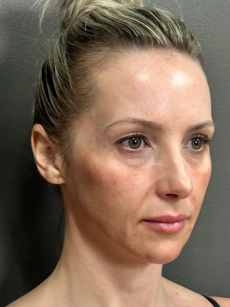 Full Face Rejuvenation Before & After Gallery - Patient 257029 - Image 3