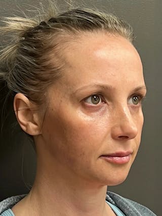 Full Face Rejuvenation Before & After Gallery - Patient 257029 - Image 4