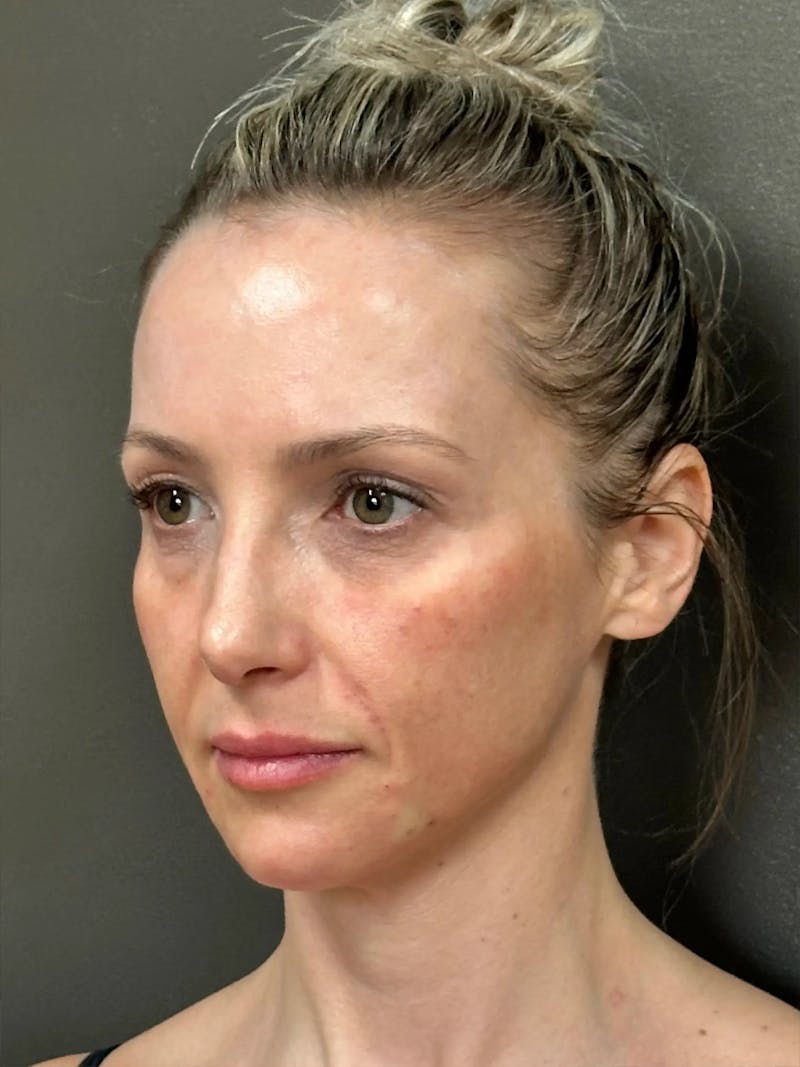 Full Face Rejuvenation Before & After Gallery - Patient 257029 - Image 5