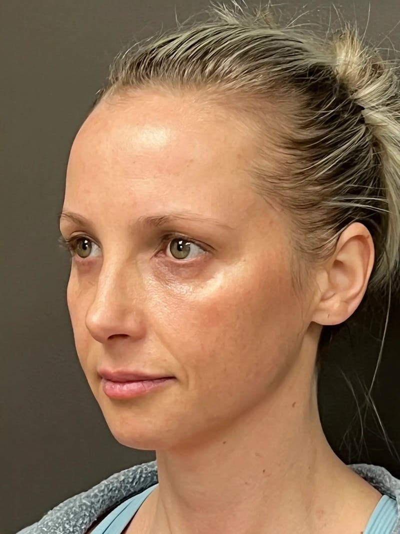 Full Face Rejuvenation Before & After Gallery - Patient 257029 - Image 6