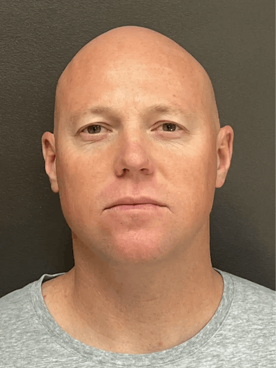 Full Face Rejuvenation Before & After Gallery - Patient 111243 - Image 1