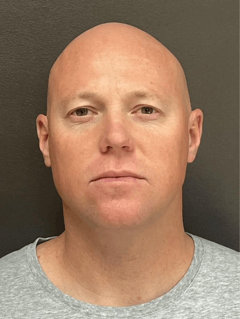 Full Face Rejuvenation Before & After Gallery - Patient 111243 - Image 1