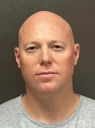 Full Face Rejuvenation Before & After Gallery - Patient 111243 - Image 2